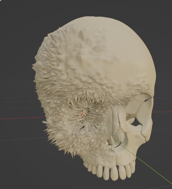 Aggressive Bone Cancer of the Skull