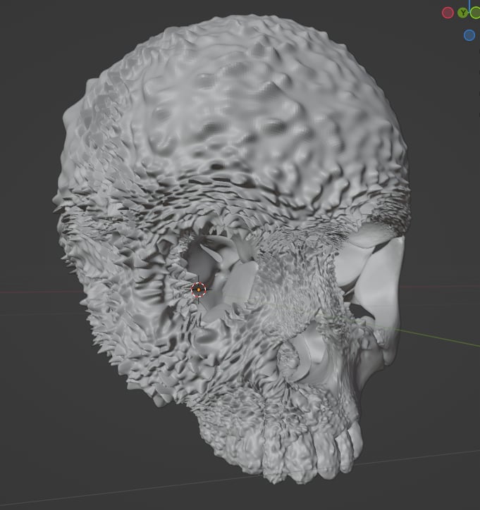 Aggressive Bone Cancer of the Skull