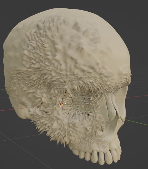 Aggressive Bone Cancer of the Skull