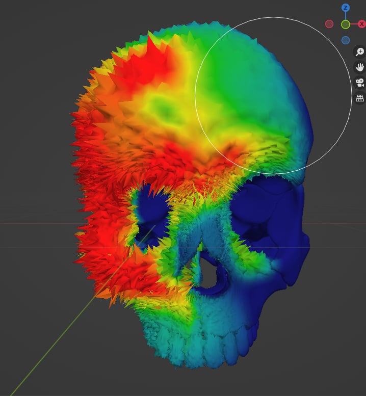 Aggressive Bone Cancer of the Skull