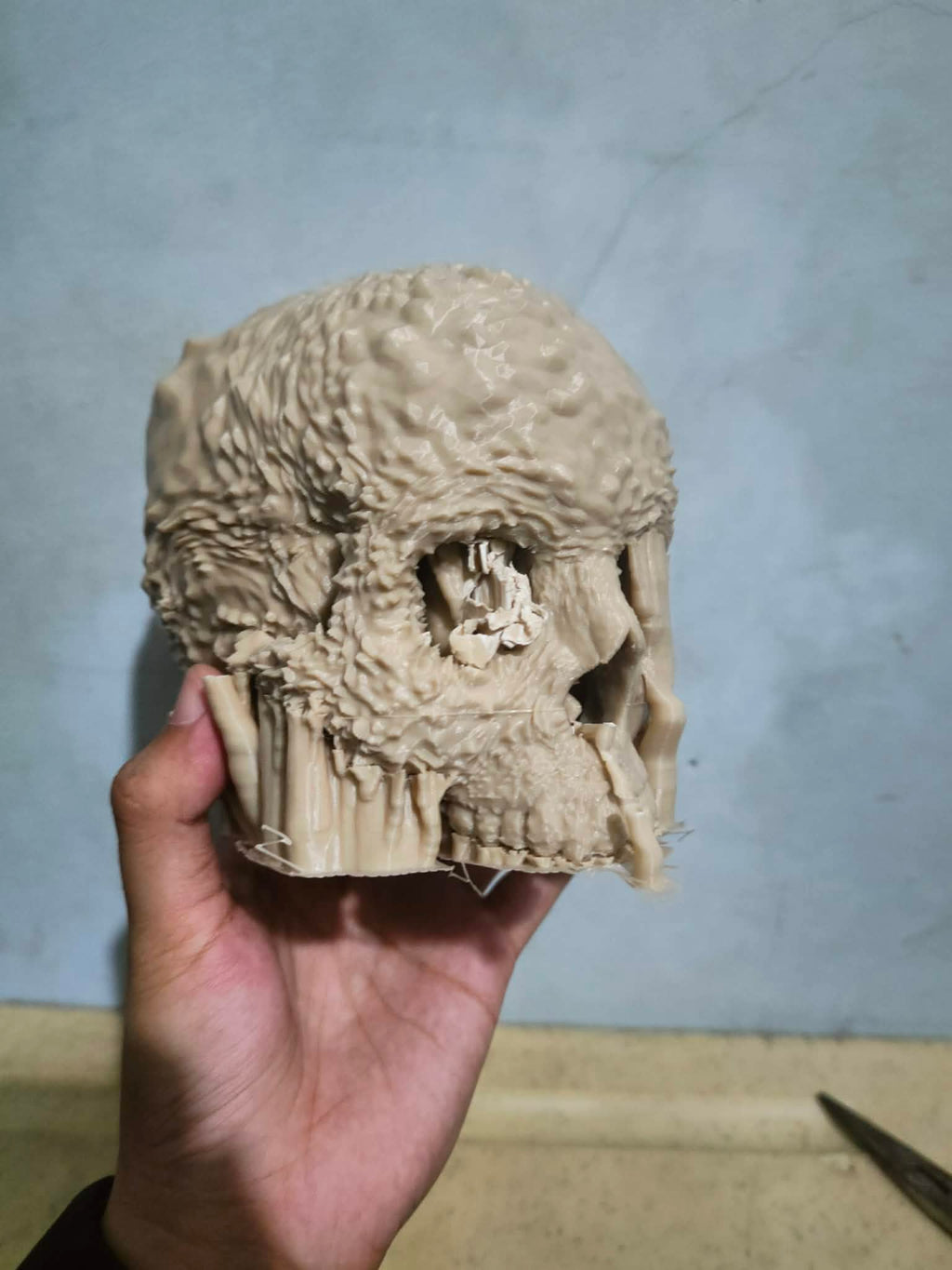 Aggressive Bone Cancer of the Skull