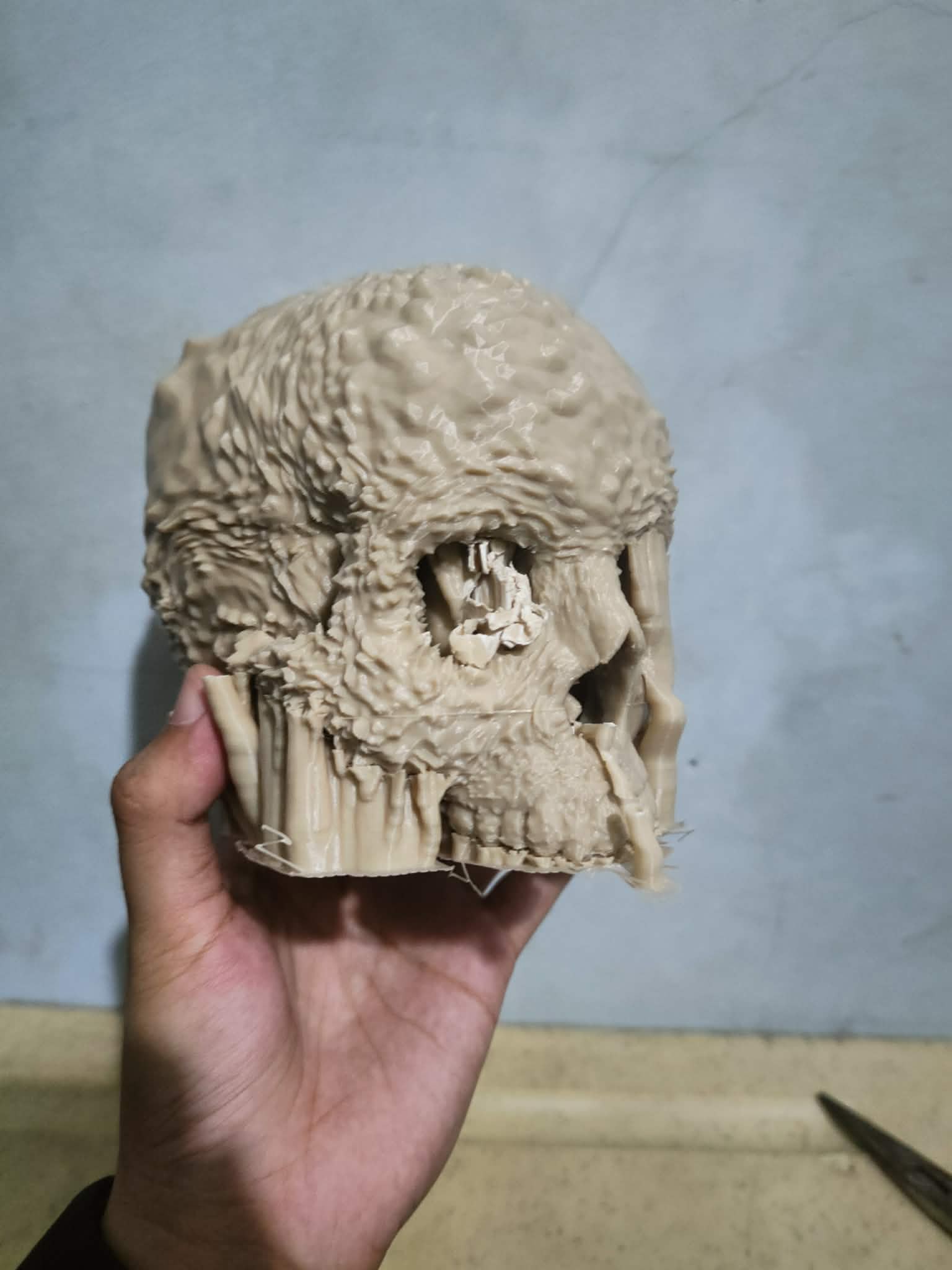 Aggressive Bone Cancer of the Skull